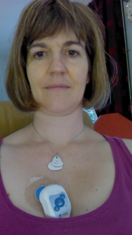 Not looking quite my best today! The ECG is attached to one pad on the chest wall and via a lead to another pad below the left armpit. The monitor can be unclipped to shower.